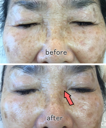 60代主婦/お悩み:シワが深くなってきた